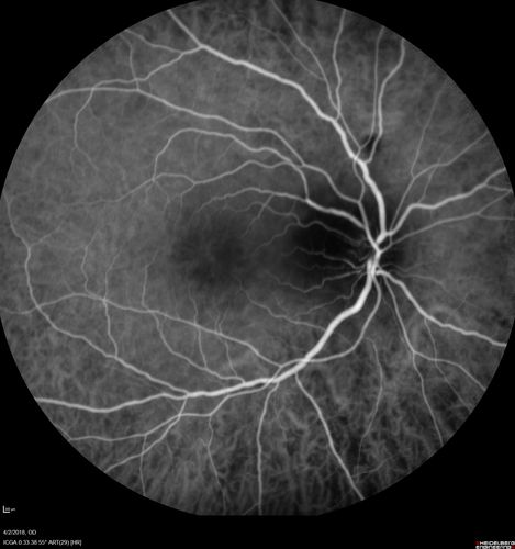 Cat Scratch - Neuroretinitis OD AND retinitis OS - Bartonella henselae positive
27 year old female with exposure to cats and prior fever.  Reports with recent vision loss right eye.  She was treated with doxycycline and within 2 weeks the right eye looks better.  Then she skipped all follow-up visits.  The right eye presented 20/200 and the left 20/16
