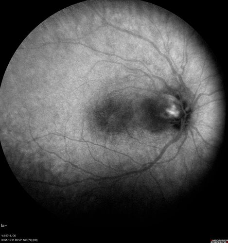 Cat Scratch - Neuroretinitis OD AND retinitis OS - Bartonella henselae positive
27 year old female with exposure to cats and prior fever.  Reports with recent vision loss right eye.  She was treated with doxycycline and within 2 weeks the right eye looks better.  Then she skipped all follow-up visits.  The right eye presented 20/200 and the left 20/16
