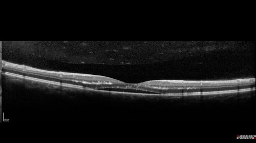 Cat Scratch - Neuroretinitis OD AND retinitis OS - Bartonella henselae positive
27 year old female with exposure to cats and prior fever.  Reports with recent vision loss right eye.  She was treated with doxycycline and within 2 weeks the right eye looks better.  Then she skipped all follow-up visits.  The right eye presented 20/200 and the left 20/16
