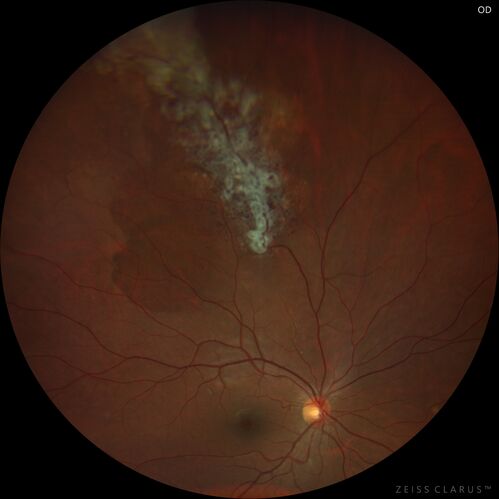 Retinal Cavernous Hemangioma
27 year old female with normal vision - MRI was normal
