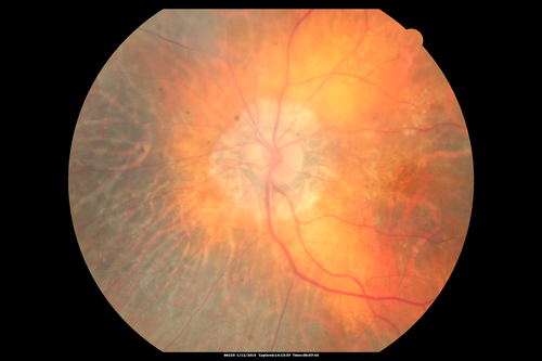 Choroideremia - Female Carrier - Patchy Atrophy of Choroid and RPE - Lyonization
