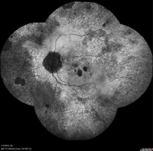 Choroideremia - Female Carrier - Patchy Atrophy of Choroid and RPE - Lyonization
