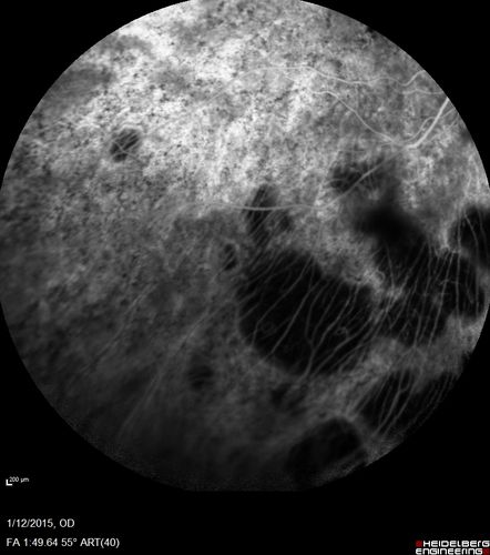 Choroideremia - Female Carrier - Patchy Atrophy of Choroid and RPE - Lyonization
