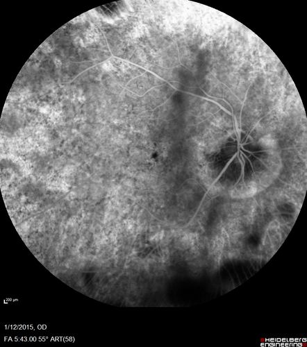 Choroideremia - Female Carrier - Patchy Atrophy of Choroid and RPE - Lyonization
