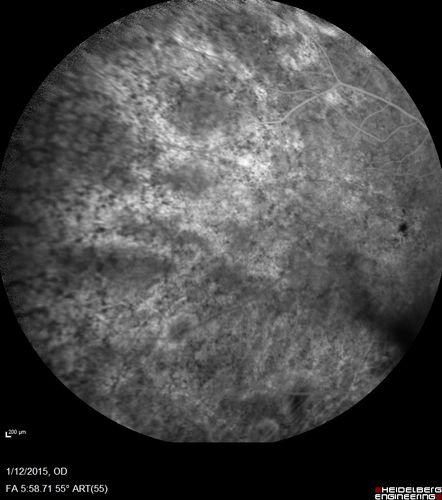 Choroideremia - Female Carrier - Patchy Atrophy of Choroid and RPE - Lyonization
