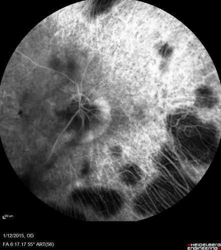 Choroideremia - Female Carrier - Patchy Atrophy of Choroid and RPE - Lyonization
