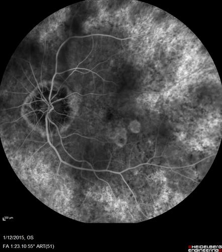Choroideremia - Female Carrier - Patchy Atrophy of Choroid and RPE - Lyonization
