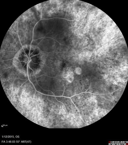 Choroideremia - Female Carrier - Patchy Atrophy of Choroid and RPE - Lyonization
