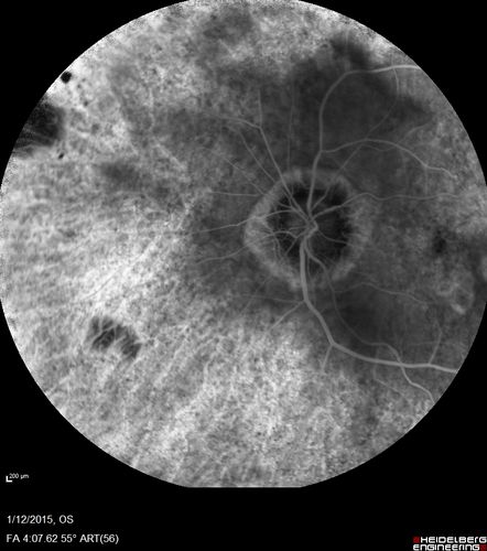 Choroideremia - Female Carrier - Patchy Atrophy of Choroid and RPE - Lyonization

