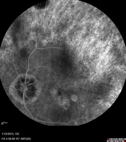 Choroideremia - Female Carrier - Patchy Atrophy of Choroid and RPE - Lyonization
