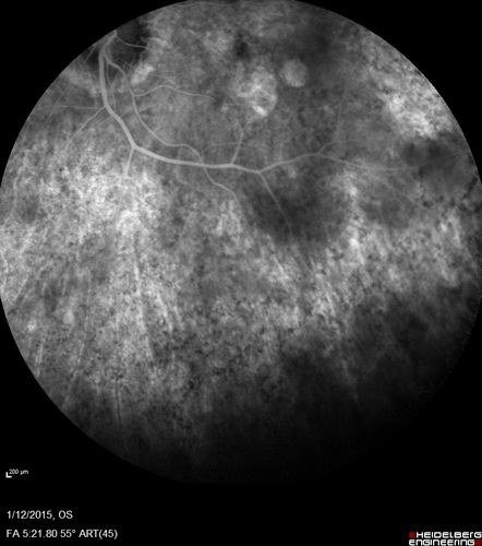 Choroideremia - Female Carrier - Patchy Atrophy of Choroid and RPE - Lyonization

