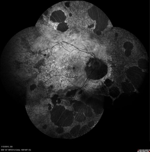 Choroideremia - Female Carrier - Patchy Atrophy of Choroid and RPE - Lyonization
