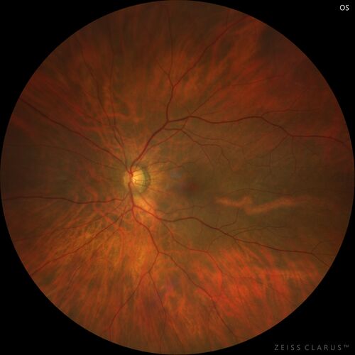 Choroidal macrovessel
70 year old female with vision loss in the left eye 4 months after cataract surgery.
VA 20/32 OD, 20/80 OS
Images show CME but also a choroidal macrovessel in the left eye.
