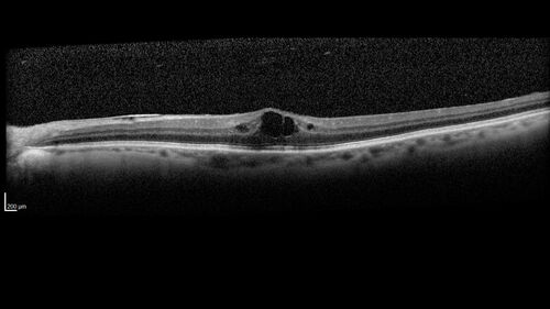 Choroidal macrovessel
70 year old female with vision loss in the left eye 4 months after cataract surgery.
VA 20/32 OD, 20/80 OS
Images show CME but also a choroidal macrovessel in the left eye.
