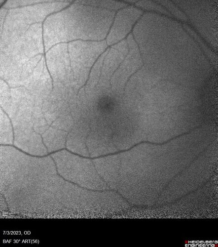 Choroidal macrovessel
70 year old female with vision loss in the left eye 4 months after cataract surgery.
VA 20/32 OD, 20/80 OS
Images show CME but also a choroidal macrovessel in the left eye.
