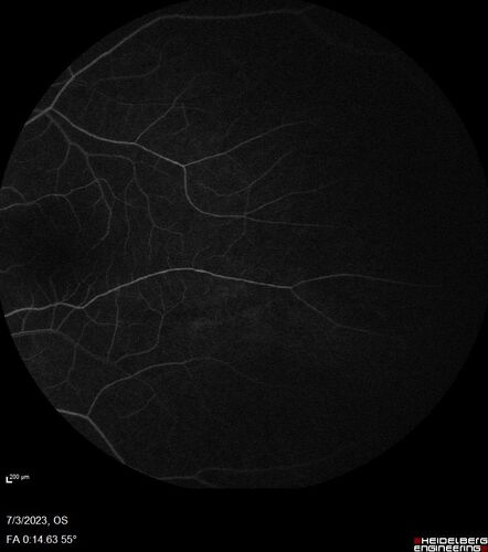 Choroidal macrovessel
70 year old female with vision loss in the left eye 4 months after cataract surgery.
VA 20/32 OD, 20/80 OS
Images show CME but also a choroidal macrovessel in the left eye.
