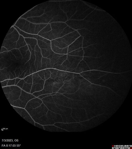 Choroidal macrovessel
70 year old female with vision loss in the left eye 4 months after cataract surgery.
VA 20/32 OD, 20/80 OS
Images show CME but also a choroidal macrovessel in the left eye.
