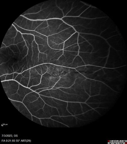 Choroidal macrovessel
70 year old female with vision loss in the left eye 4 months after cataract surgery.
VA 20/32 OD, 20/80 OS
Images show CME but also a choroidal macrovessel in the left eye.
