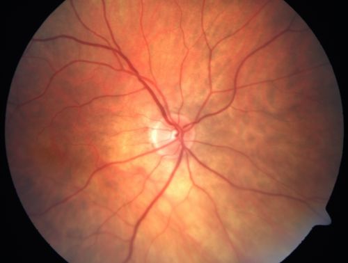Cilioretinal artery occlusion and Ophthalmic Artery Occlusion with Relative Sparing of the Central Retinal Artery
80-year-old woman who says she was looking in the mirror, covered her right eye and noticed she could not see well out of the left eye.  That just happened yesterday.  Her last eye check was a few years ago.  She also had a carotid endarterectomy on the right side in 2006 shortly after coronary bypass surgery.  OD is 20/40, OS is 20/200.
