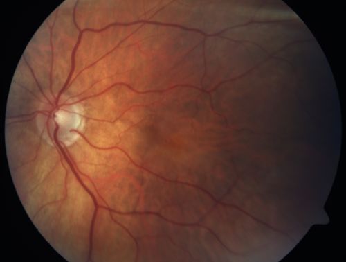 Cilioretinal artery occlusion and Ophthalmic Artery Occlusion with Relative Sparing of the Central Retinal Artery
80-year-old woman who says she was looking in the mirror, covered her right eye and noticed she could not see well out of the left eye.  That just happened yesterday.  Her last eye check was a few years ago.  She also had a carotid endarterectomy on the right side in 2006 shortly after coronary bypass surgery.  OD is 20/40, OS is 20/200.
