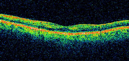 Cilioretinal artery occlusion and Ophthalmic Artery Occlusion with Relative Sparing of the Central Retinal Artery
80-year-old woman who says she was looking in the mirror, covered her right eye and noticed she could not see well out of the left eye.  That just happened yesterday.  Her last eye check was a few years ago.  She also had a carotid endarterectomy on the right side in 2006 shortly after coronary bypass surgery.  OD is 20/40, OS is 20/200.
