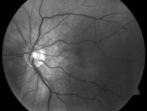 Cilioretinal artery occlusion and Ophthalmic Artery Occlusion with Relative Sparing of the Central Retinal Artery
80-year-old woman who says she was looking in the mirror, covered her right eye and noticed she could not see well out of the left eye.  That just happened yesterday.  Her last eye check was a few years ago.  She also had a carotid endarterectomy on the right side in 2006 shortly after coronary bypass surgery.  OD is 20/40, OS is 20/200.
