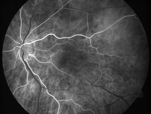 Cilioretinal artery occlusion and Ophthalmic Artery Occlusion with Relative Sparing of the Central Retinal Artery
80-year-old woman who says she was looking in the mirror, covered her right eye and noticed she could not see well out of the left eye.  That just happened yesterday.  Her last eye check was a few years ago.  She also had a carotid endarterectomy on the right side in 2006 shortly after coronary bypass surgery.  OD is 20/40, OS is 20/200.
