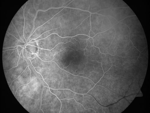 Cilioretinal artery occlusion and Ophthalmic Artery Occlusion with Relative Sparing of the Central Retinal Artery
80-year-old woman who says she was looking in the mirror, covered her right eye and noticed she could not see well out of the left eye.  That just happened yesterday.  Her last eye check was a few years ago.  She also had a carotid endarterectomy on the right side in 2006 shortly after coronary bypass surgery.  OD is 20/40, OS is 20/200.
