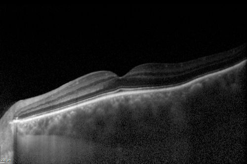 Choroidal Hemangioma - Diffuse - Enhanced Depth Imaging Spectral Domain OCT Line Scan - Abnormal Eye
Choroidal Thickness is 697 Microns from Diffuse Choroidal Hemangioma
