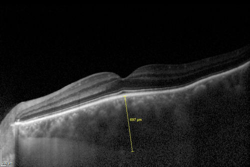 Choroidal Hemangioma - Diffuse - Enhanced Depth Imaging Spectral Domain OCT Line Scan - Abnormal Eye
Choroidal Thickness is 697 Microns from Diffuse Choroidal Hemangioma
