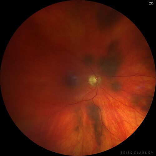 Choroidal Melanocystosis
65 year old female with normal vision.

