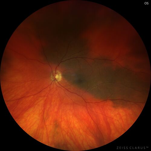 Choroidal Melanocystosis
65 year old female with normal vision.
