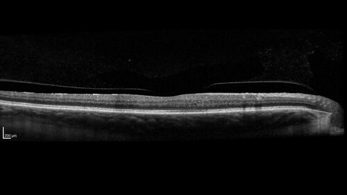 Choroidal Melanocystosis
65 year old female with normal vision.
