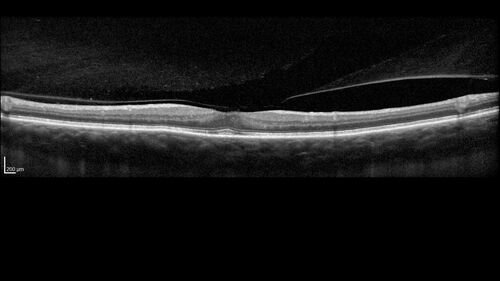 Choroidal Melanocystosis
65 year old female with normal vision.
