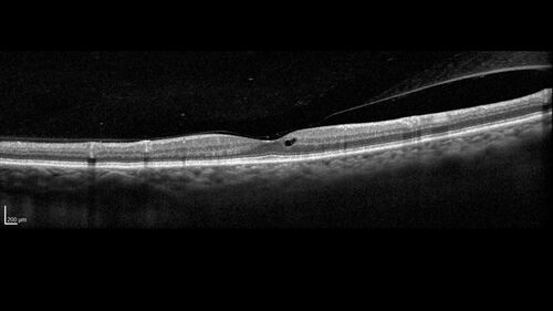 Choroidal Melanocystosis
65 year old female with normal vision.
