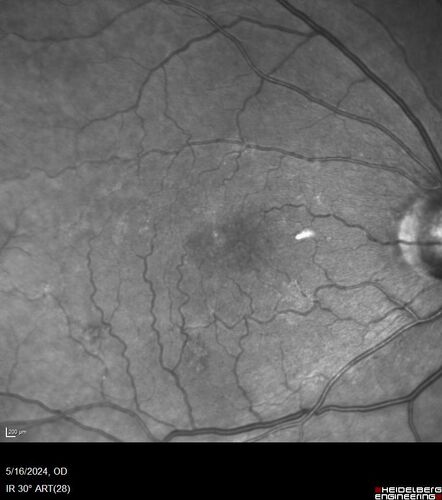 Choroidal Melanocystosis
65 year old female with normal vision.
