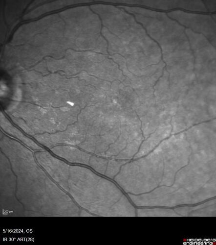 Choroidal Melanocystosis
65 year old female with normal vision.
