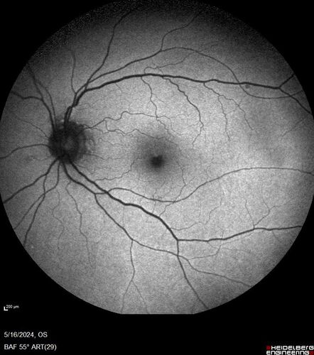 Choroidal Melanocystosis
65 year old female with normal vision.
