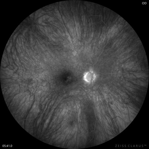 Choroidal Melanocystosis
65 year old female with normal vision.
