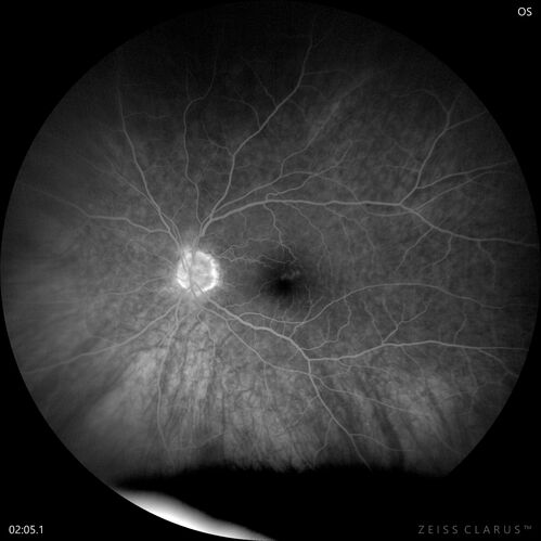 Choroidal Melanocystosis
65 year old female with normal vision.
