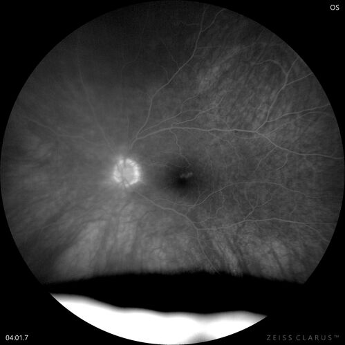 Choroidal Melanocystosis
65 year old female with normal vision.
