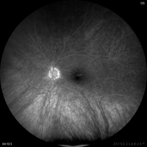 Choroidal Melanocystosis
65 year old female with normal vision.
