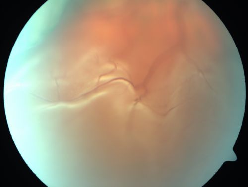Choroidal Melanoma (Medium) Exudative Retinal Detachment 
87-year-old man noticed a new onset floater a few months ago. OD is 20/40, OS is 20/30
