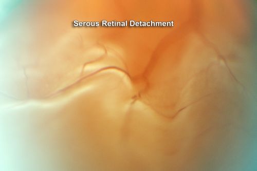 Choroidal Melanoma (Medium) Exudative Retinal Detachment 
87-year-old man noticed a new onset floater a few months ago. OD is 20/40, OS is 20/30

