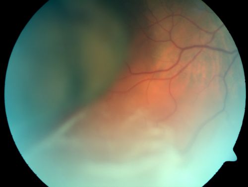 Choroidal Melanoma (Medium) Exudative Retinal Detachment 
87-year-old man noticed a new onset floater a few months ago. OD is 20/40, OS is 20/30
