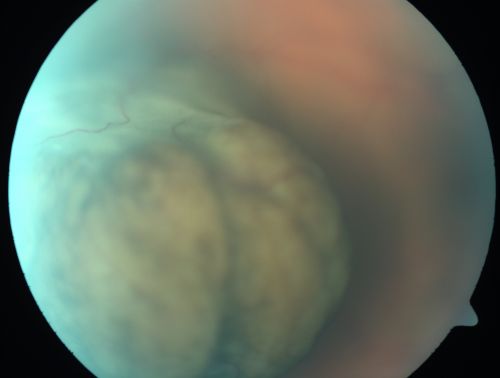 Choroidal Melanoma (Medium) Exudative Retinal Detachment 
87-year-old man noticed a new onset floater a few months ago. OD is 20/40, OS is 20/30
