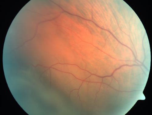 Choroidal Melanoma (Medium) Exudative Retinal Detachment 
87-year-old man noticed a new onset floater a few months ago. OD is 20/40, OS is 20/30
