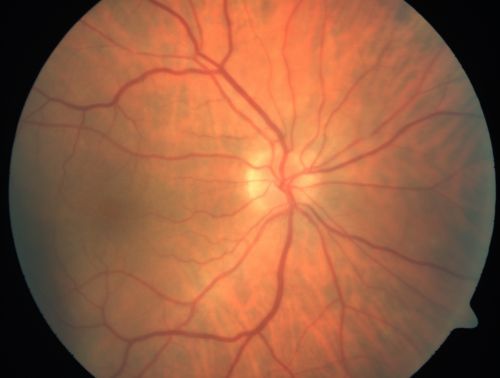 Choroidal Melanoma (Medium) Exudative Retinal Detachment 
87-year-old man noticed a new onset floater a few months ago. OD is 20/40, OS is 20/30
