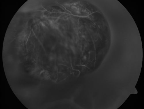 Choroidal Melanoma (Medium) Exudative Retinal Detachment 
87-year-old man noticed a new onset floater a few months ago. OD is 20/40, OS is 20/30
