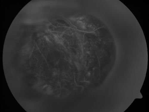 Choroidal Melanoma (Medium) Exudative Retinal Detachment 
87-year-old man noticed a new onset floater a few months ago. OD is 20/40, OS is 20/30
